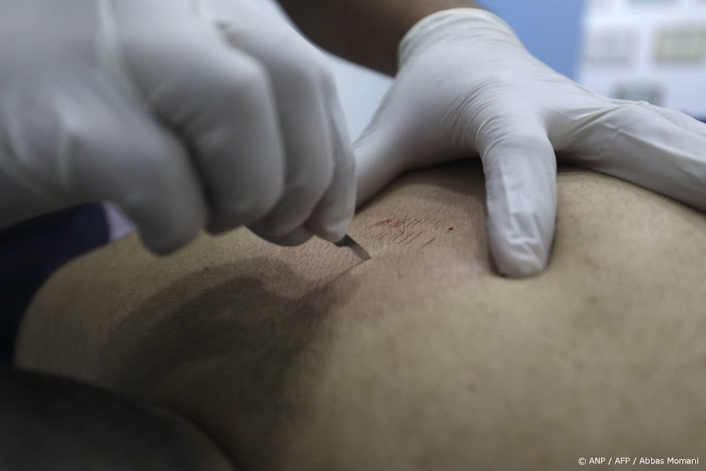 Aanbieders alternatieve behandeling 'wet cupping' vaak onbevoegd