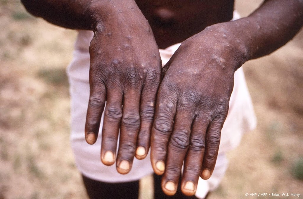 Snellere verspreiding mpox in Democratische Republiek Congo