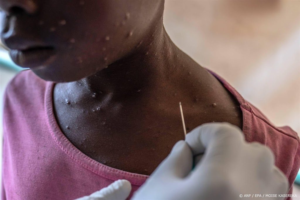 Mpox-vaccin van Bavarian Nordic goedgekeurd voor jongeren