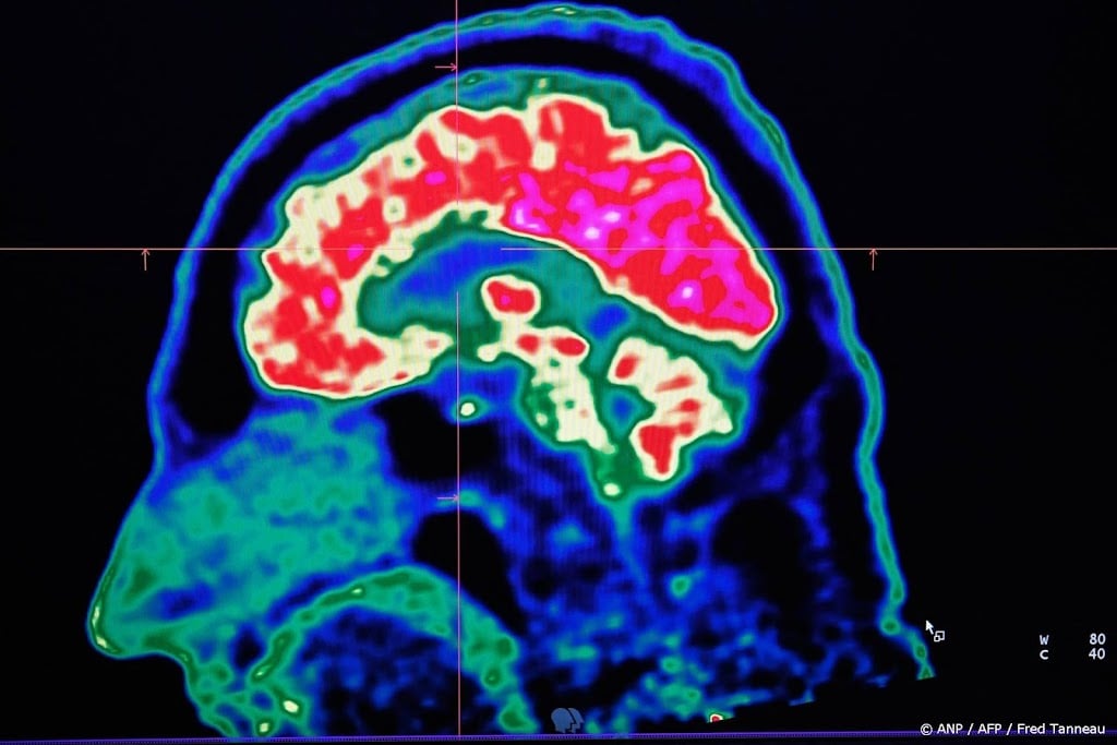 Hersenstichting: aantal mensen met hersenaandoening loopt op