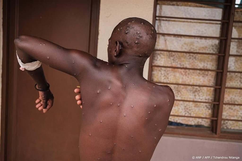 RIVM 'staat klaar' voor eerste geval mpox in Nederland