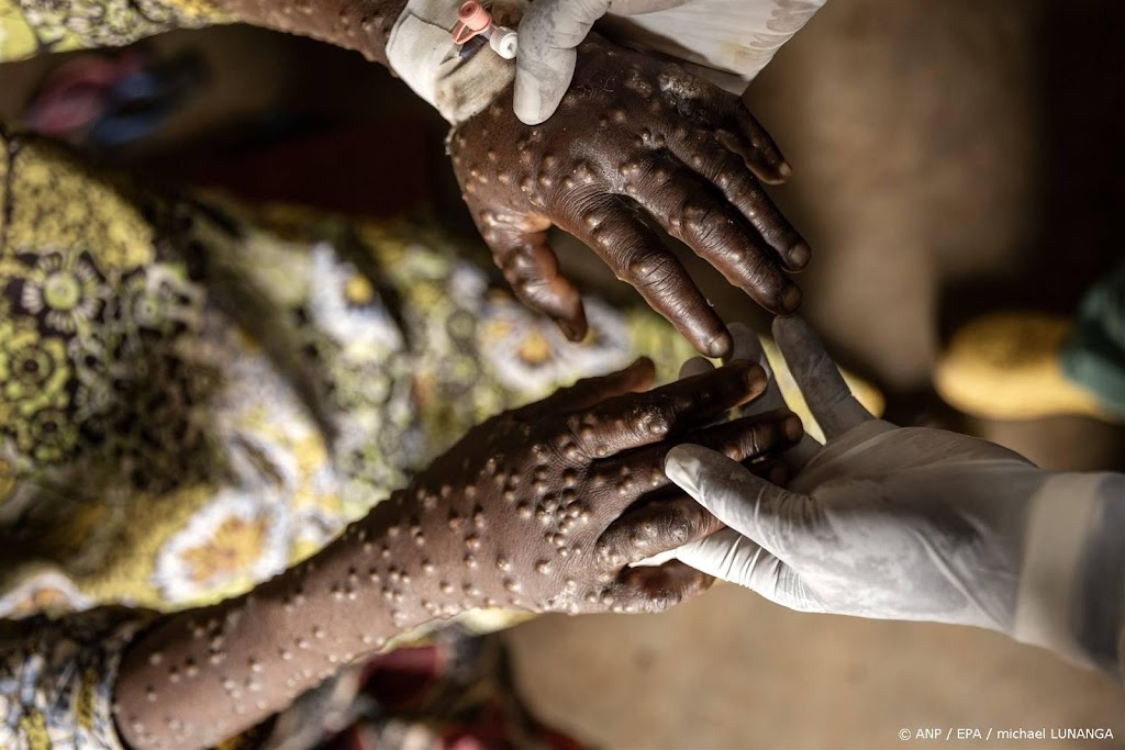 Tienduizenden vermoedelijke mpox-besmettingen in Afrika dit jaar