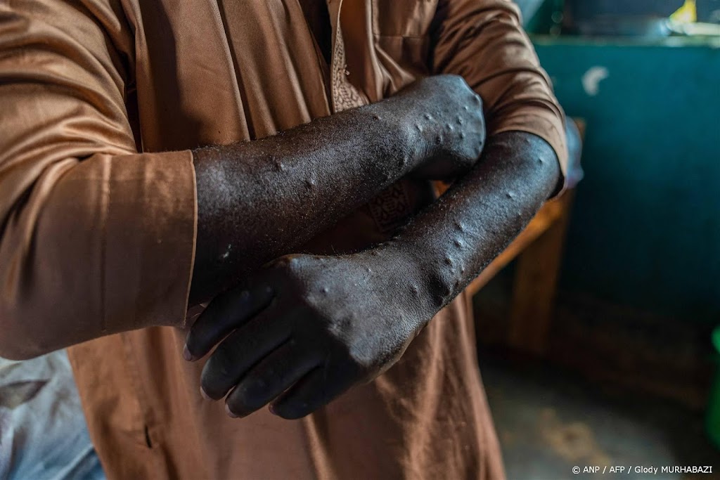 Mpox-variant duikt nu ook op in België