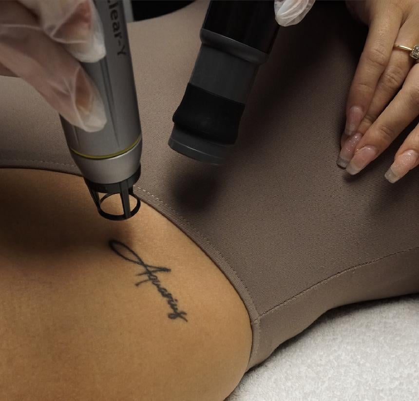 Laser ontharen in Kapelle " GRATIS INTAKE twv €49"