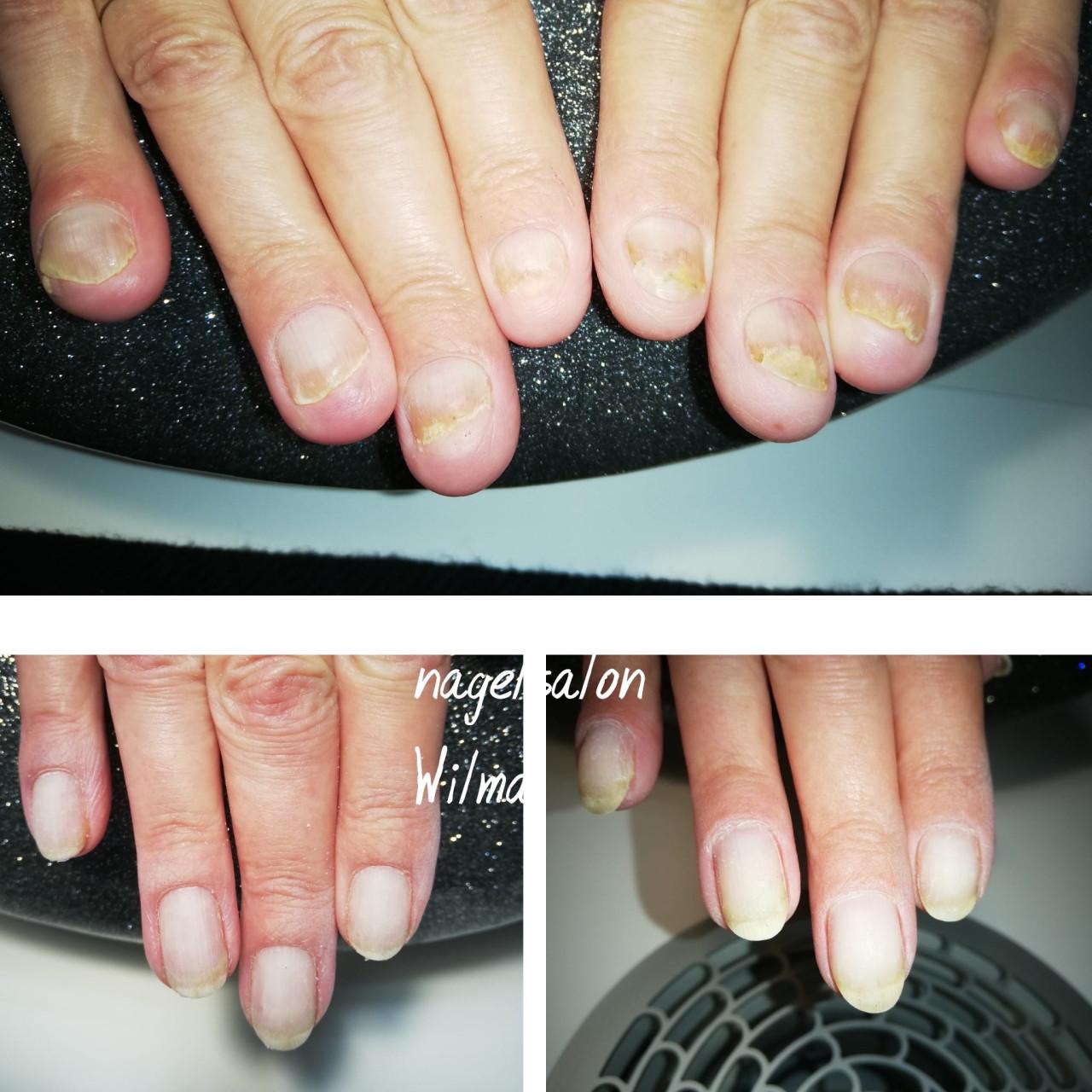 Nagelbijtersarrangement